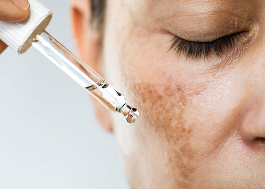O Que é o Efeito Rebote no Melasma e Como Evitá-lo
