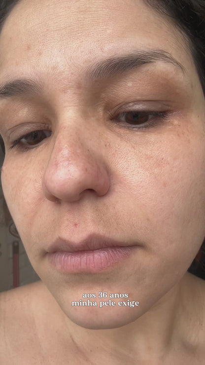 Kit Tratamento para Melasma